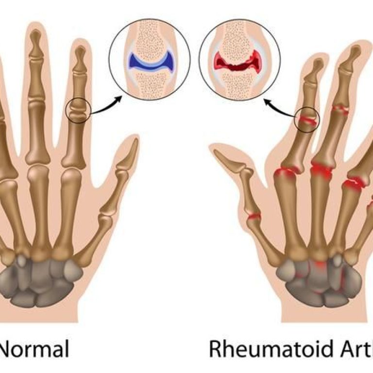 How Compression Sleeves Can Help Rheumatoid Arthritis